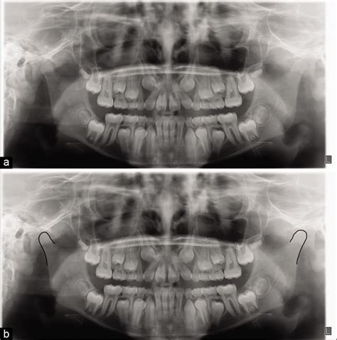 Optimal Use Of A Panoramic Radiograph As A Screening Tool For Condylar