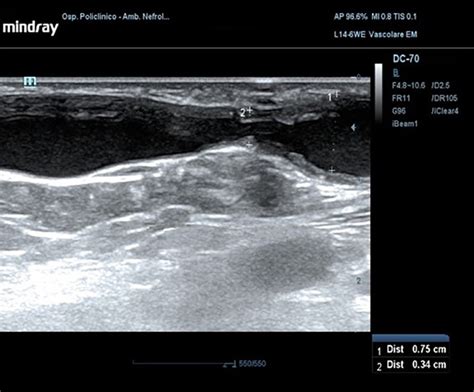 Thrombosis Of The Basilic Vein Observed With A Linear Probe In Download Scientific Diagram