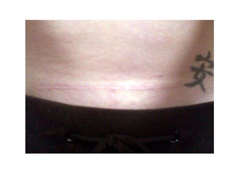 Cesarean Scar Tattoo