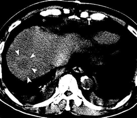 Sparing Of Fatty Infiltration Around Focal Hepatic Lesions In Patients