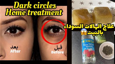 Dark Circles Best And Easy Home Remedy احسن وأسهل طريقة لعلاج الهالات