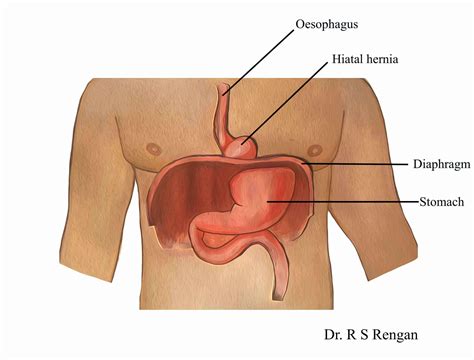 Can Babies Have Hiatal Hernia Life Size Newsletter Fonction