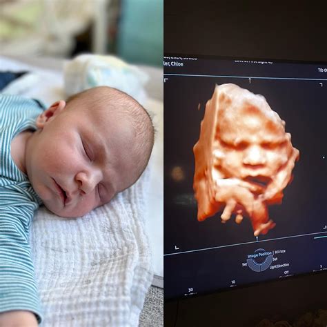 Baby Profile Ultrasound