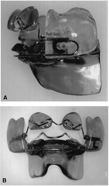 Skeletal And Dental Modifications Produced By The Bionator Iii Appliance American Journal Of