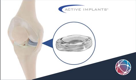 Active Implants Nusurface® Meniscus Implant Provides Statistically