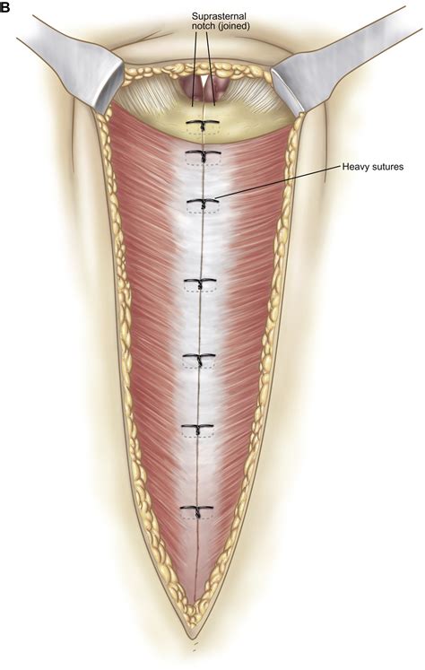 Surgical Approaches For Invasive Tumors Of The Anterior Mediastinum