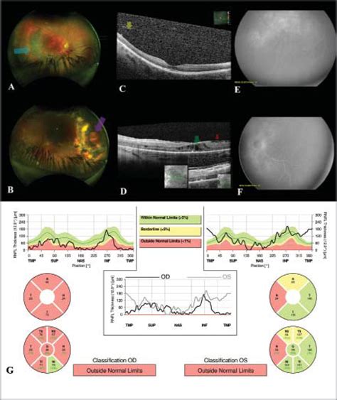 Multimodal Retinal Imaging Findings In Two Cousins With VCAN Related