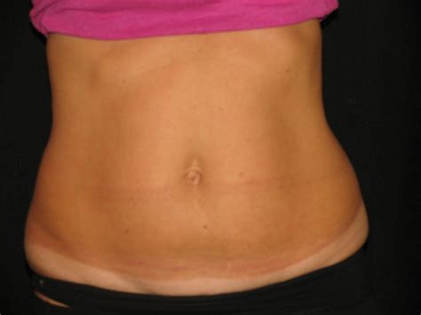 Top Myths About Coolsculpting You Should Stop Believing