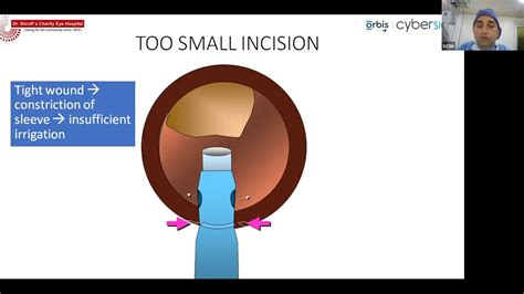 Live Surgical Demonstration: Basics of Phacoemulsification - Dr. Umang ...