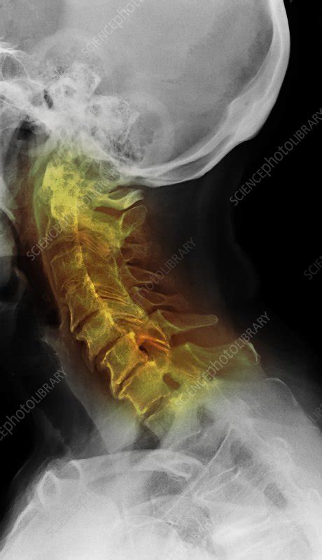 Osteoarthritis Of The Cervical Spine X Ray Stock Image F0281813 Science Photo Library