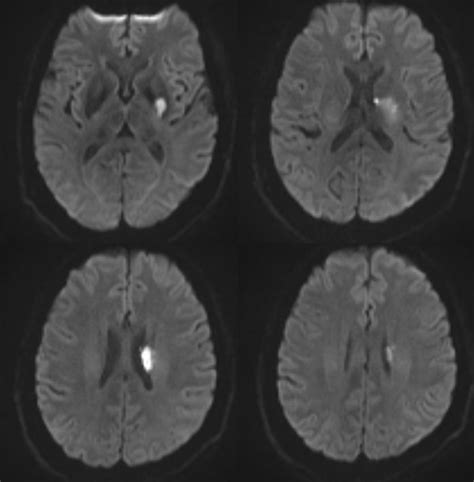 Anterior Choroidal Artery