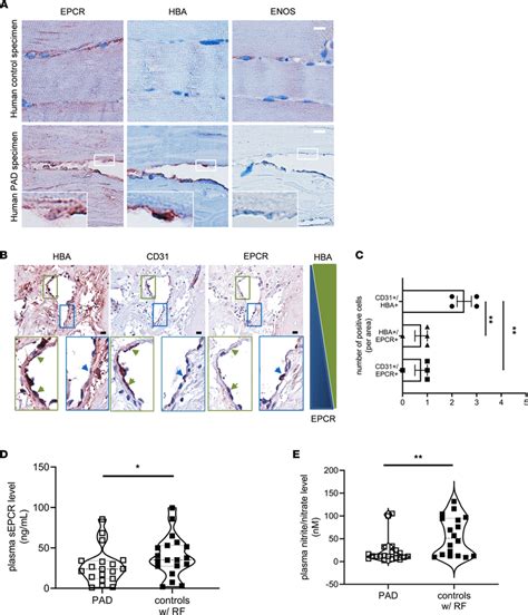 Endothelial Epcr And Hemoglobin Expression And Soluble Epcr Plasma