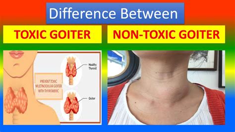 Nontoxic Uninodular Goiter