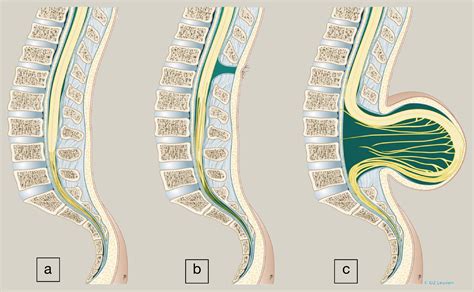 Spina Bifida Spine