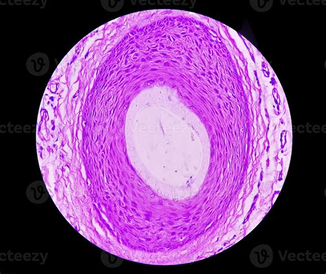 Histological Biopsy Of Scrotal Wall Under Microscopy Showing Calcinosis