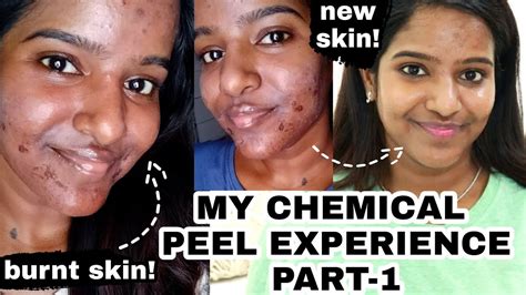 My Chemical Peel Experience Session1 Before And After Skin Update