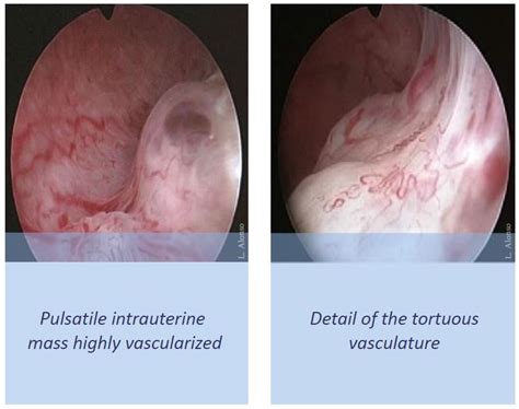 Uterine Arteriovenous Malformation Hysteroscopy Newsletter