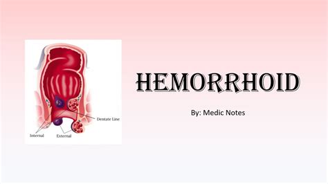 Hemorrhoid Classification Risk Factor Investigation Treatment