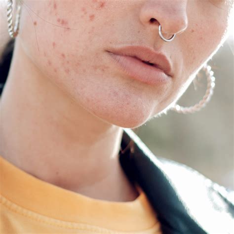 You Can Get Acne Everywhere Even Your Vagina Sunday Edit