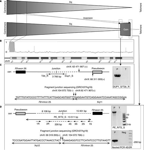 Severe Hemophilia A Caused By An Unbalanced Chromosomal Rearrangement