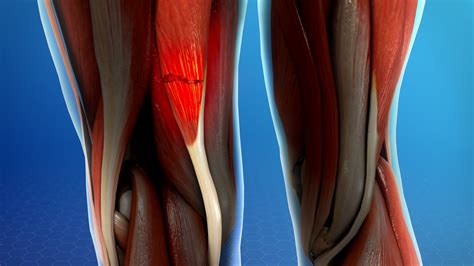 Lesiones Musculares Enfoque Clinico FYD 2018 Congreso FYD 2018