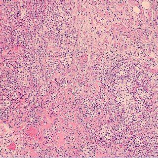 Pleural pathology: malignant mesothelioma demonstrated. | Download ...