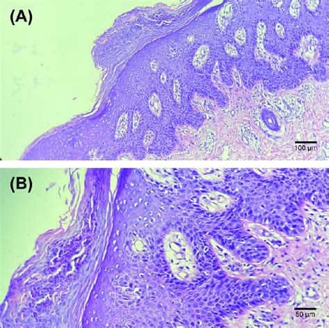 Histological Examination Of The Skin Biopsy Showing Typical Features Of