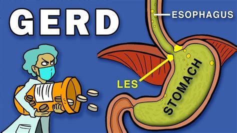 Gastroesophageal Reflux Disease (GERD) - YouTube