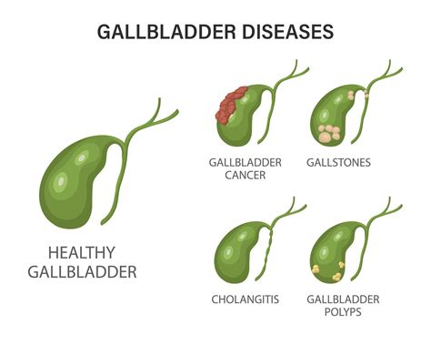 Gallbladder Diseases Infographics Gallstone Disease Cancer Acute