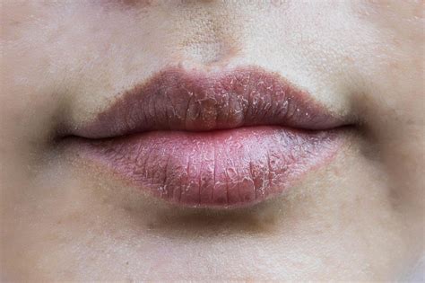 Lábios Escuros O Que Pode Ser - Lábios escuros são normais? Causas e tratamentos