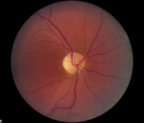 Optometry Atlas Optic Nerve Conditions Viewpoint