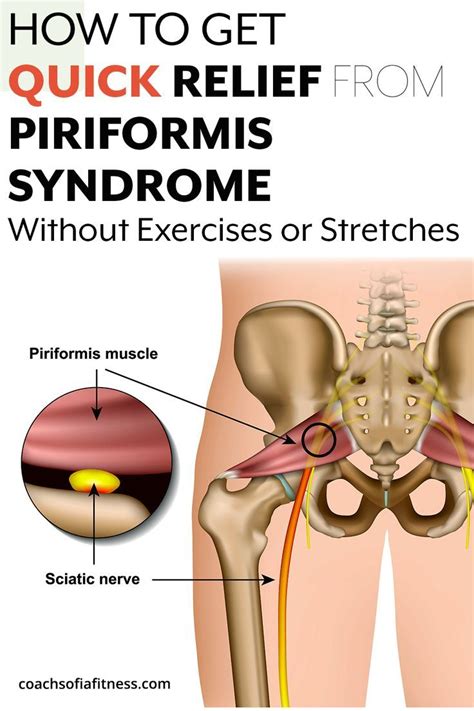 Sciatica Or Piriformis Syndrome Artofit