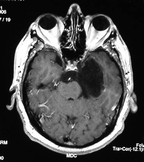 Mri T1 Weighted Images Axial View Showing Epidermoid Cyst Arising In