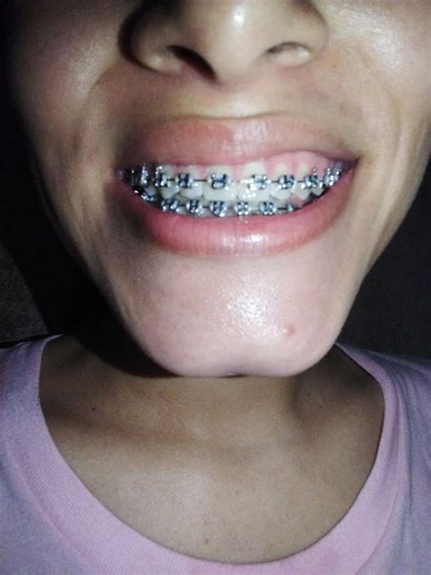 Braces Colors For Girls