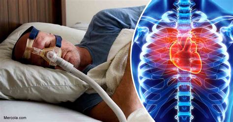 Sleep Apnea May Be A Risk Factor For Heart Disease