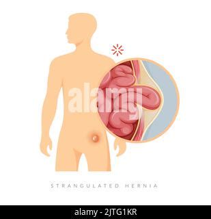 Strangulated Hernia Section Of The Small Intestines Stock