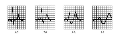 Image:ECG patterns in hyperkalemia-Merck Manual Professional Edition