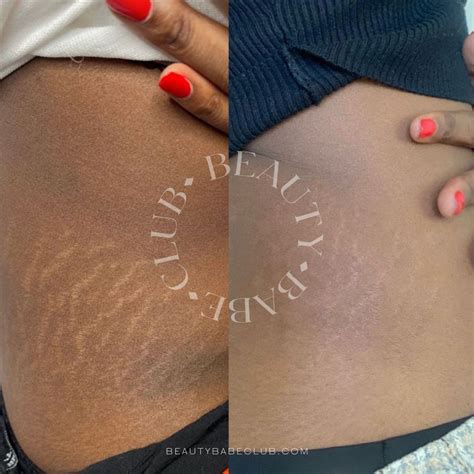 Semi Permanent Makeup For Stretch Marks Saubhaya Makeup