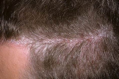 Symptoms Of Scalp Psoriasis Pictures Symptoms And Pictures