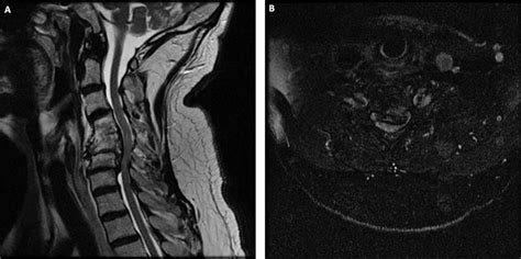 Cervical Myelopathy Clinical Tree