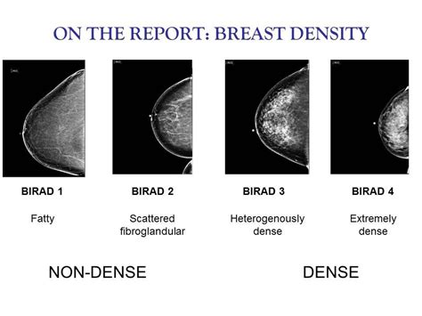 Breast Density From A Radiologists Perspective Youtube