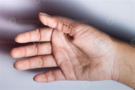 Close Up Of A Hand Wound With Stitches Thumb Wound On White Background