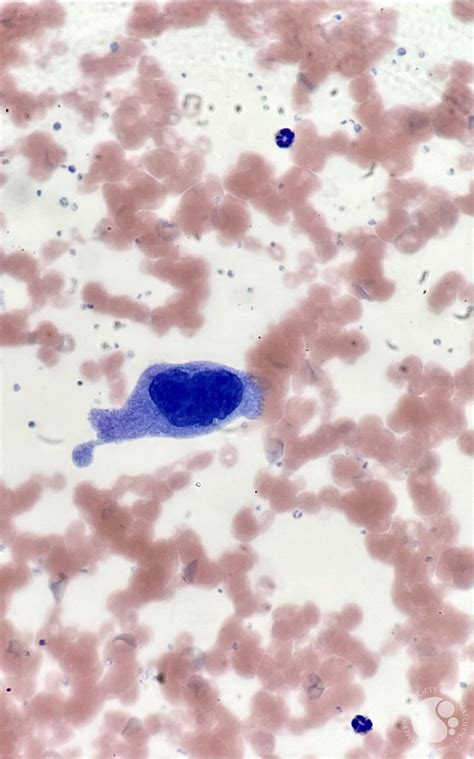 Megakaryocytes In Peripheral Blood Smear