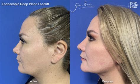 Pre Y Post Endoscopic Deep Plane Facelift Caso Lifting Facial De