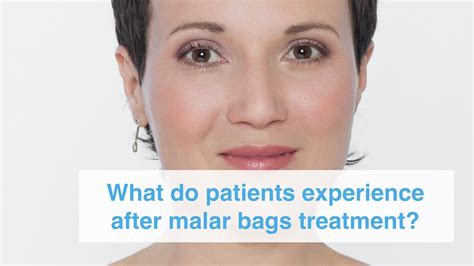 What Do Patients Experience After Malar Bags Treatment Youtube