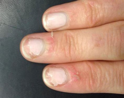 Foolproof Ways To Permanently Stop Biting Your Nails