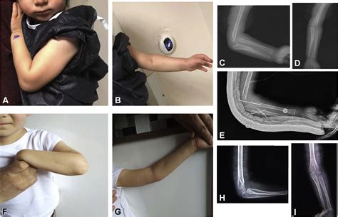 Use Of Corrective Ulnar Osteotomy And Radial Head Relocation Into