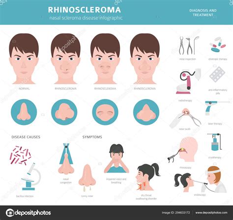 Nasal Diseases Rhinoscleroma Symptoms Nasal Scleroma Treatment Stock