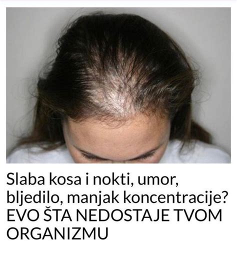 Opadanje Kose Ili Alopecija Uzrok Simptomi I Par Trikova Kako To