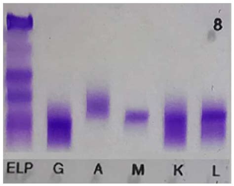 Serum Immunofixation Electrophoresis Number 8 Marked On The Image Is